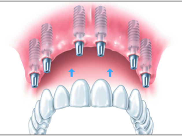 Zahnloser-Kiefer-Implantat